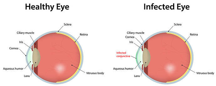 Konjungtivitis