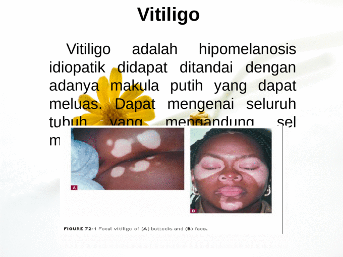 Apakah yang dimaksud dengan Vitiligo  Ilmu Kedokteran 