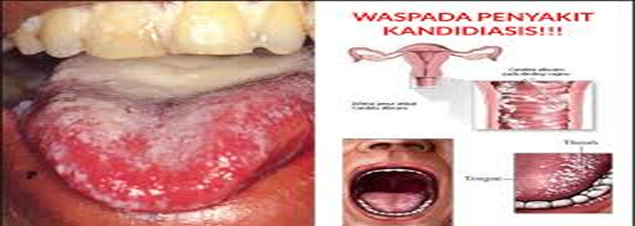 Bagaimana Cara Menyembuhkan Penyakit Kandidiasis Diskusi Kesehatan Dictio Community 0096