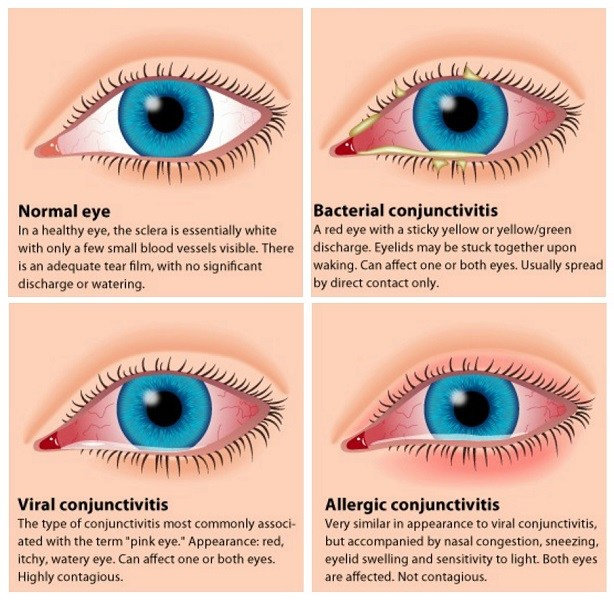 Konjungtivitis